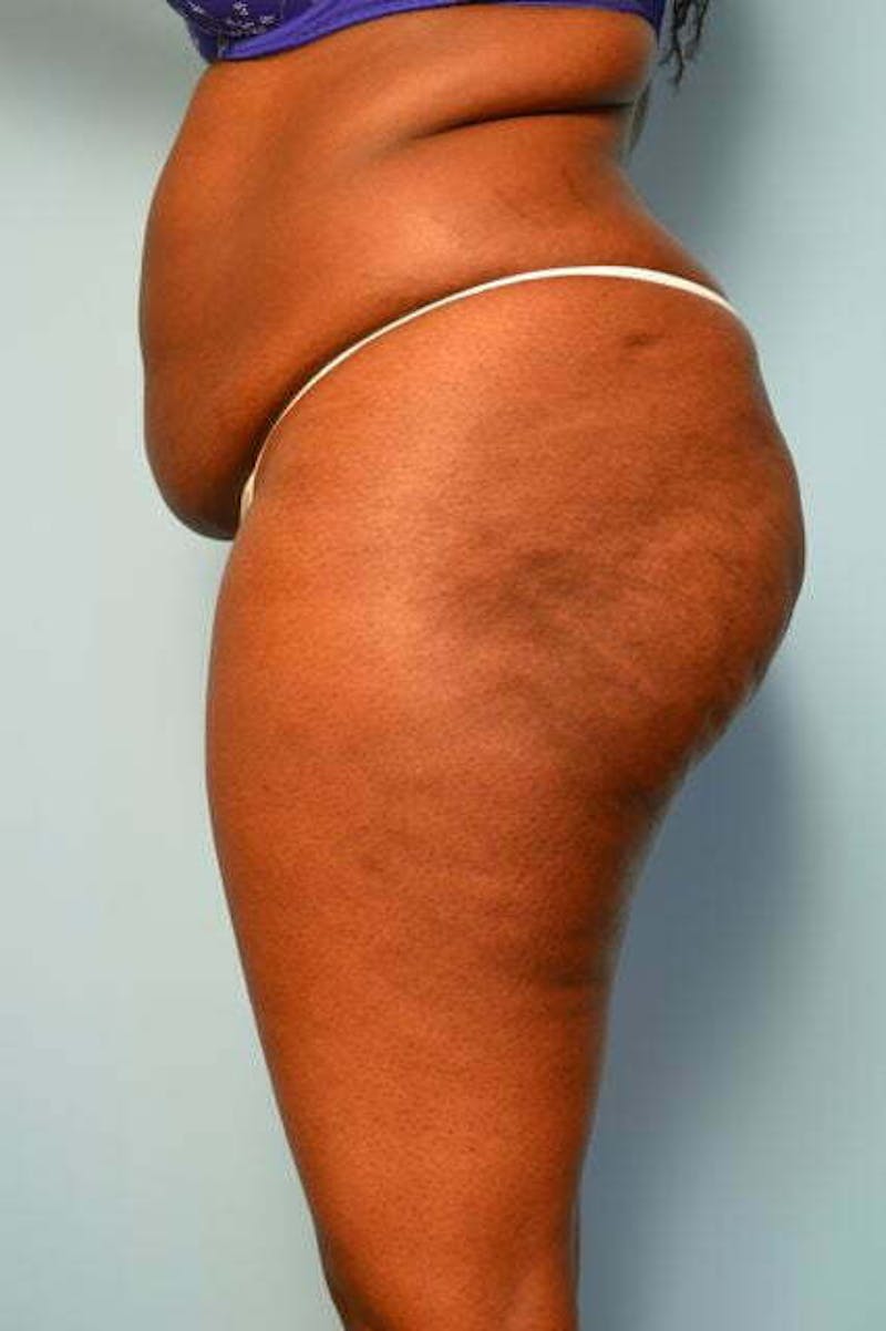 Liposuction Before & After Gallery - Patient 284770 - Image 9
