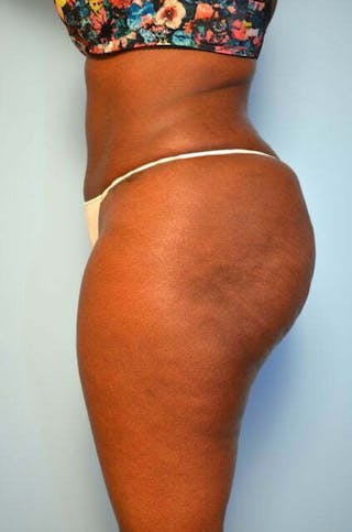 Liposuction Before & After Gallery - Patient 284770 - Image 10