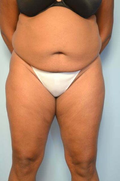 Tummy Tuck Before & After Gallery - Patient 271303 - Image 1