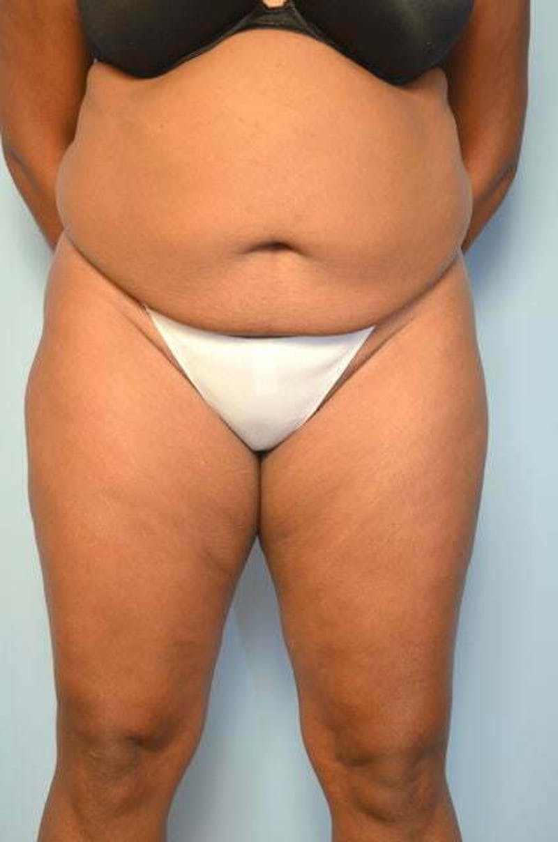 Liposuction Before & After Gallery - Patient 238846 - Image 1