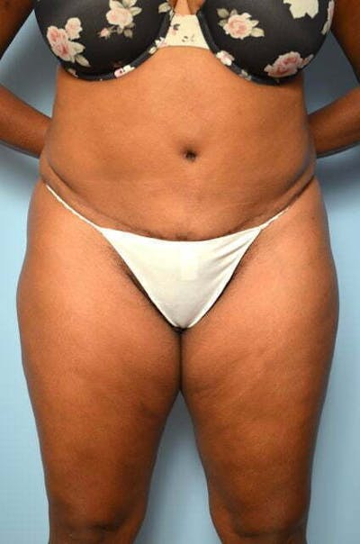 Tummy Tuck Before & After Gallery - Patient 271303 - Image 2