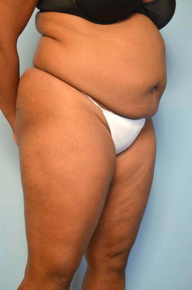 Liposuction Before & After Gallery - Patient 238846 - Image 3