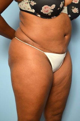 Liposuction Before & After Gallery - Patient 238846 - Image 4