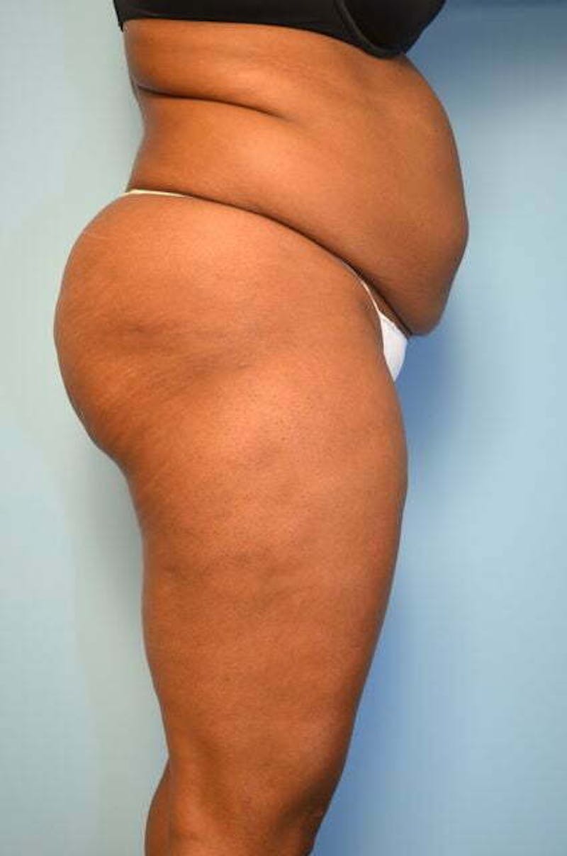 Liposuction Before & After Gallery - Patient 238846 - Image 5