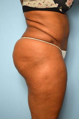 Liposuction Before & After Gallery - Patient 238846 - Image 6