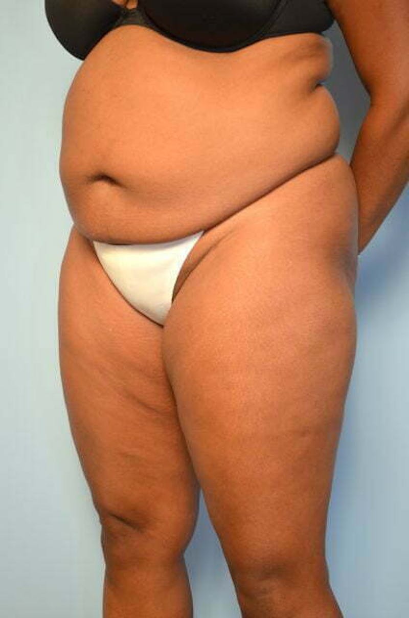 Liposuction Before & After Gallery - Patient 238846 - Image 7