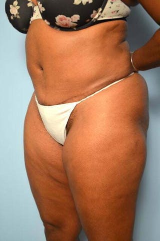 Liposuction Before & After Gallery - Patient 238846 - Image 8