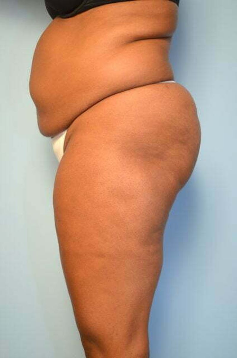 Liposuction Before & After Gallery - Patient 238846 - Image 9