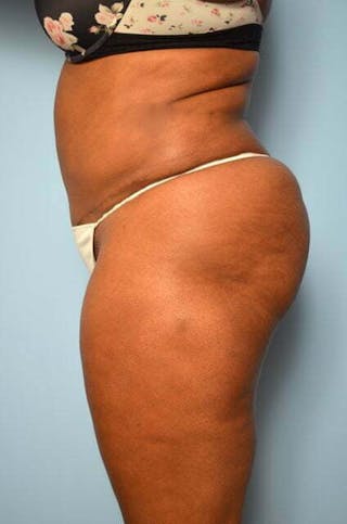 Liposuction Before & After Gallery - Patient 238846 - Image 10