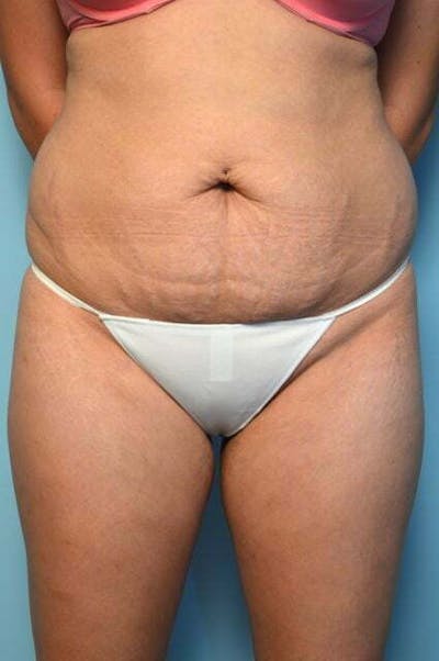 Tummy Tuck Before & After Gallery - Patient 200389 - Image 1