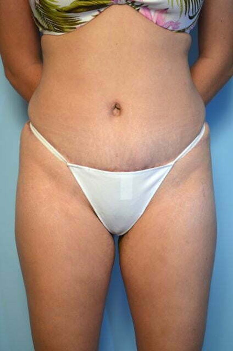 Tummy Tuck Before & After Gallery - Patient 200389 - Image 2