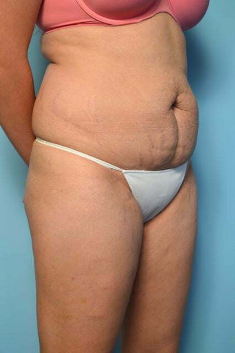 Tummy Tuck Before & After Gallery - Patient 200389 - Image 3