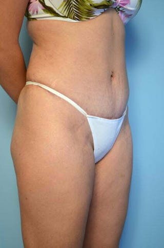 Liposuction Before & After Gallery - Patient 290235 - Image 4