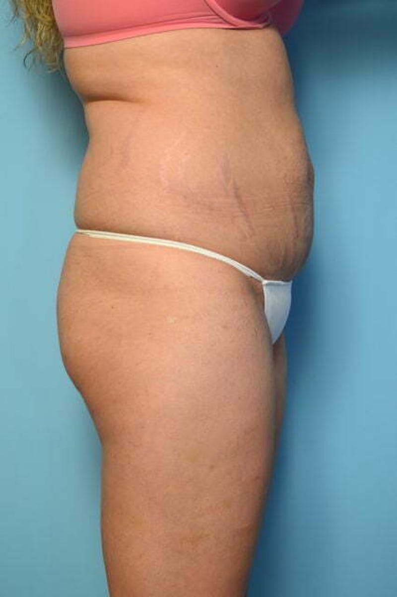 Tummy Tuck Before & After Gallery - Patient 200389 - Image 5