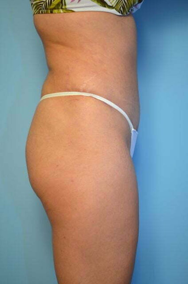 Tummy Tuck Before & After Gallery - Patient 200389 - Image 6