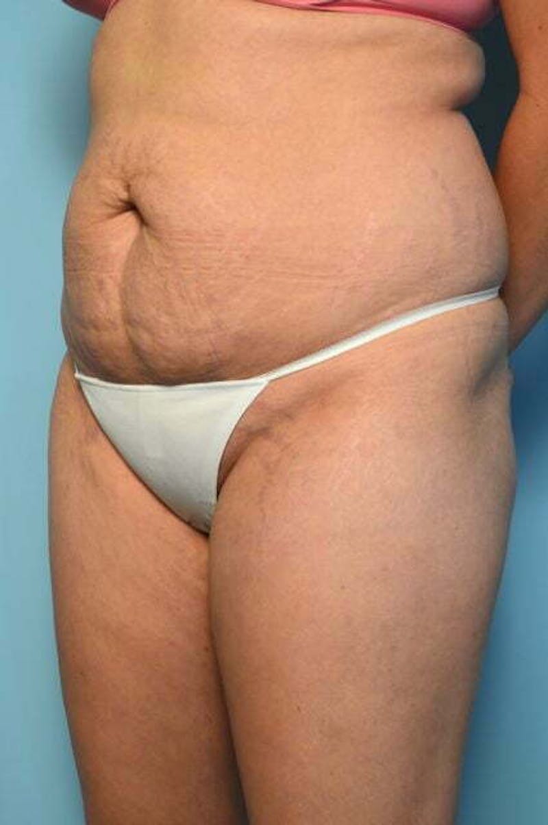 Tummy Tuck Before & After Gallery - Patient 200389 - Image 7