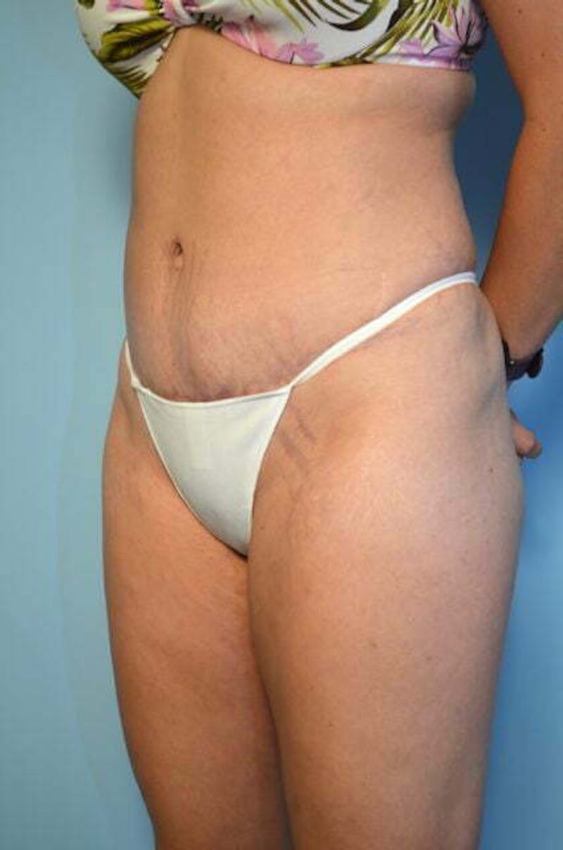 Tummy Tuck Before & After Gallery - Patient 200389 - Image 8