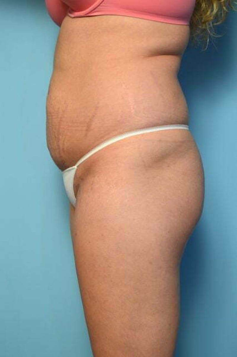 Tummy Tuck Before & After Gallery - Patient 200389 - Image 9