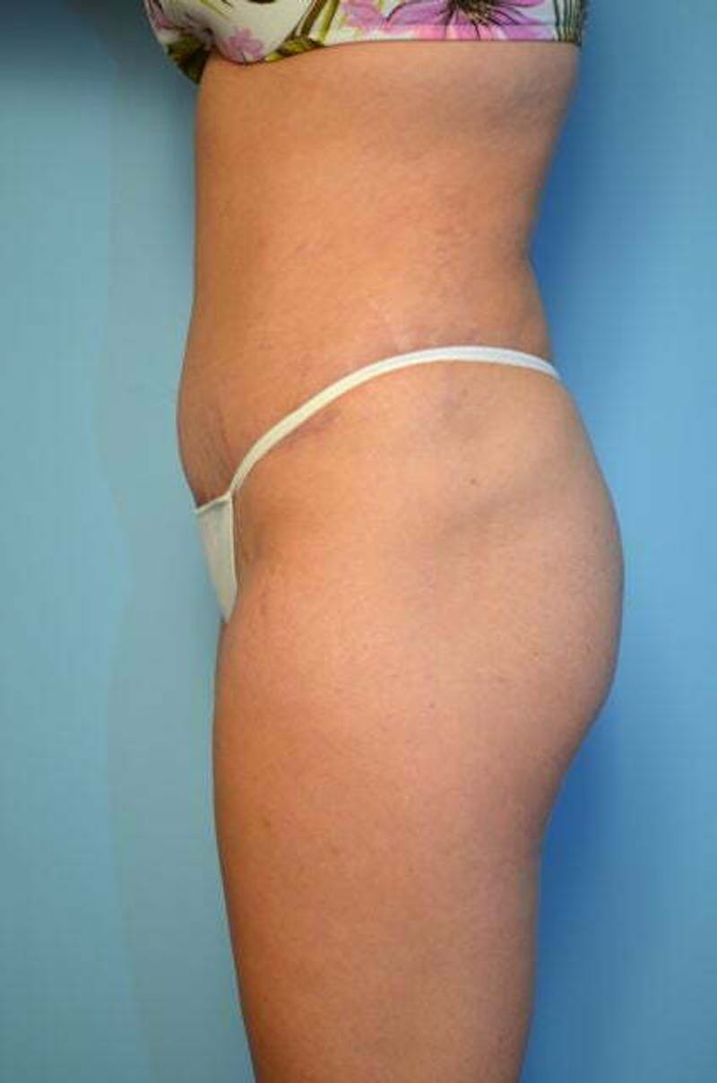 Tummy Tuck Before & After Gallery - Patient 200389 - Image 10