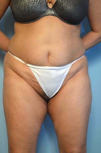 Tummy Tuck Before & After Gallery - Patient 114880 - Image 1