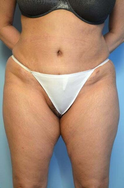 Tummy Tuck Before & After Gallery - Patient 114880 - Image 2