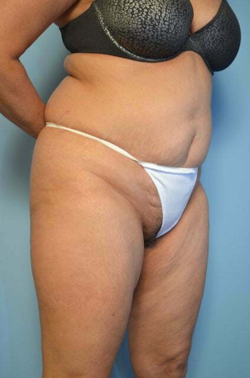 Tummy Tuck Before & After Gallery - Patient 114880 - Image 3