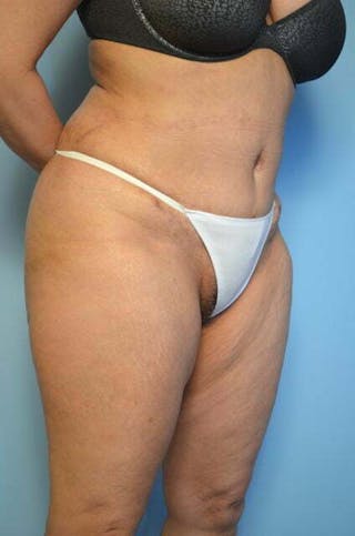 Liposuction Before & After Gallery - Patient 394224 - Image 4