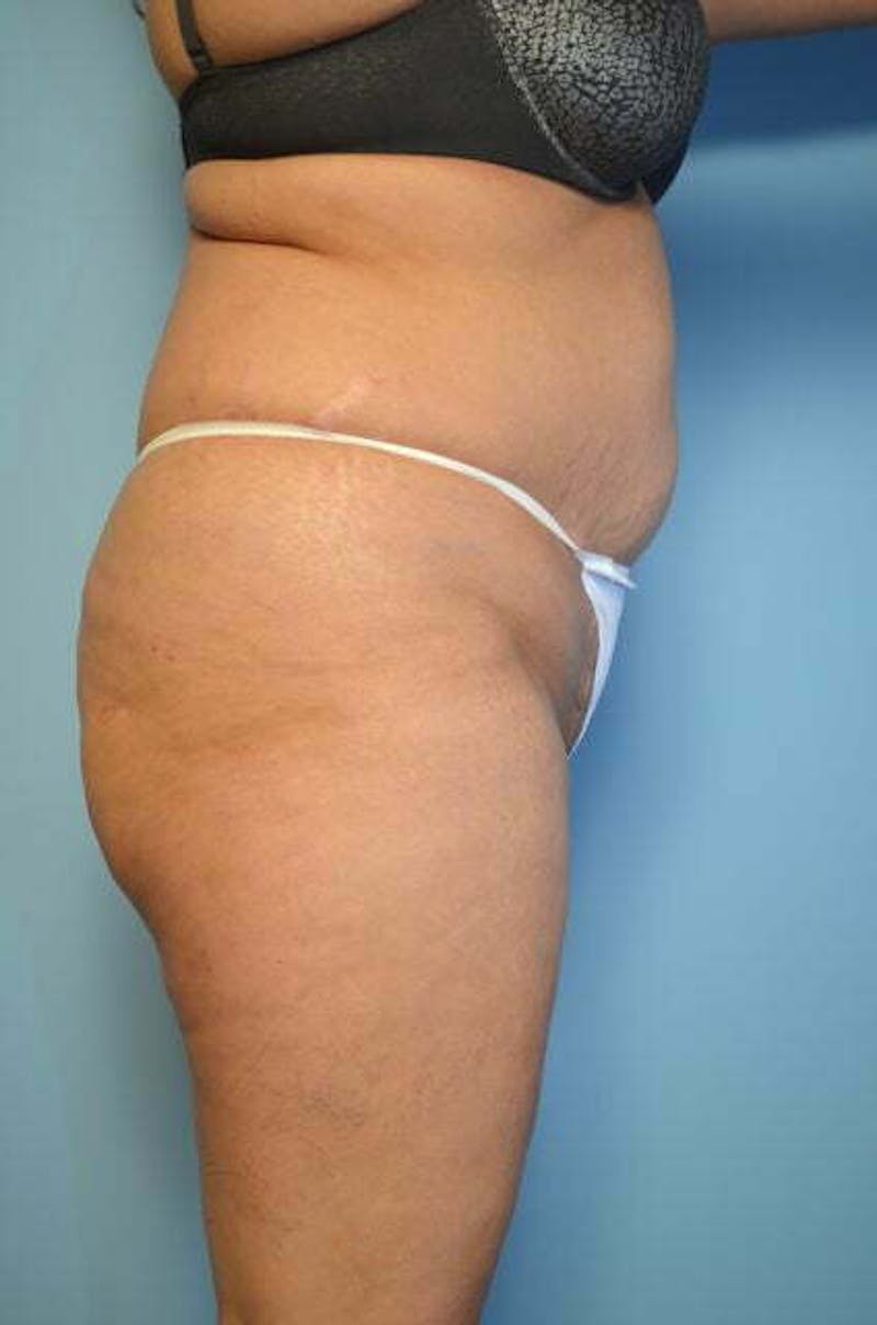 Tummy Tuck Before & After Gallery - Patient 114880 - Image 5