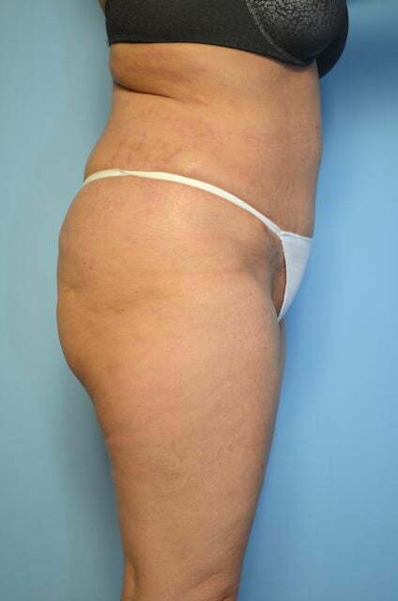 Tummy Tuck Before & After Gallery - Patient 114880 - Image 6