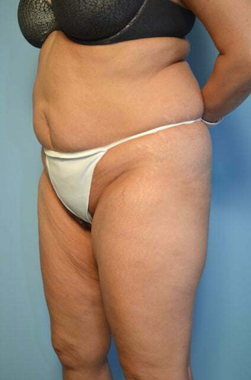 Tummy Tuck Before & After Gallery - Patient 114880 - Image 7