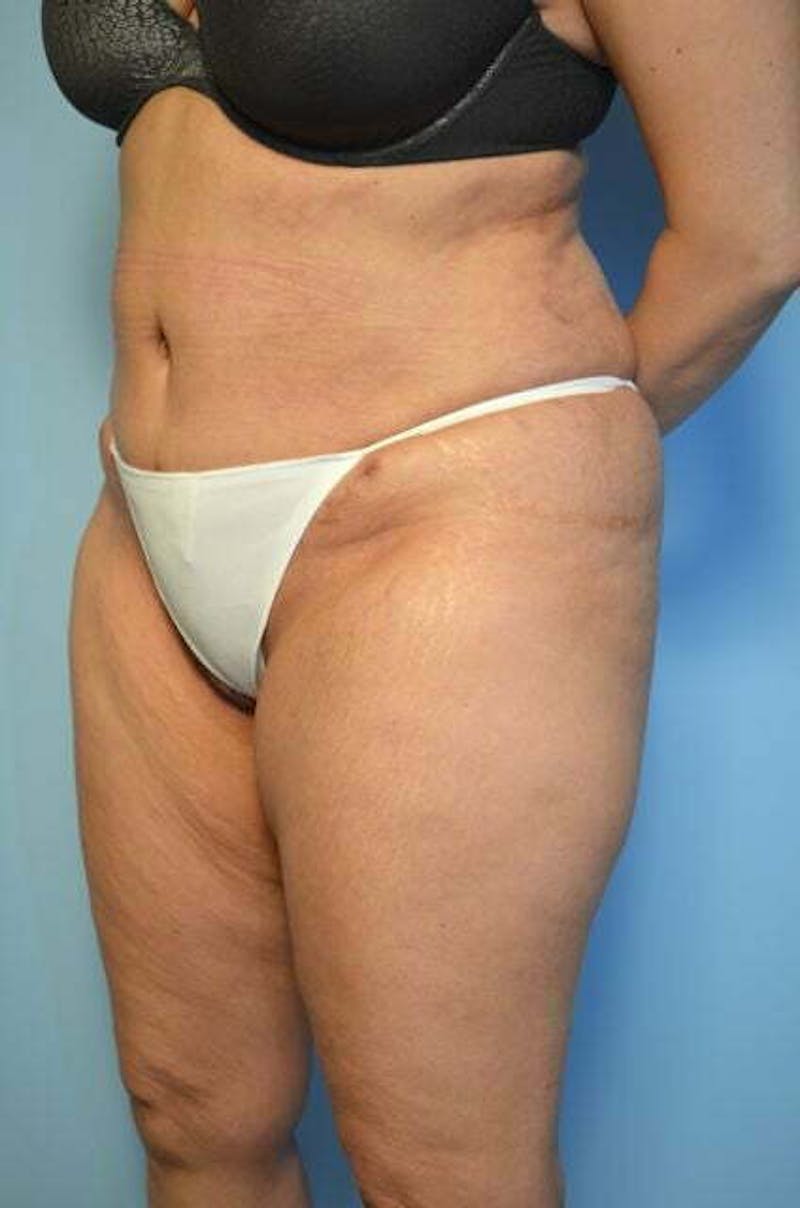 Tummy Tuck Before & After Gallery - Patient 114880 - Image 8