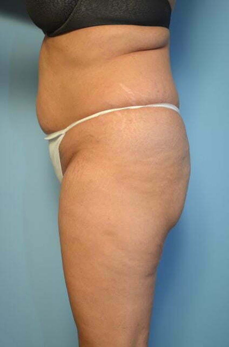 Tummy Tuck Before & After Gallery - Patient 114880 - Image 9