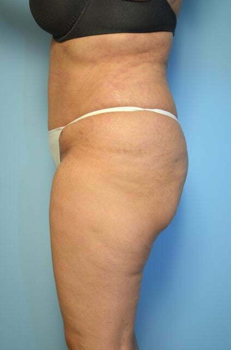 Tummy Tuck Before & After Gallery - Patient 114880 - Image 10