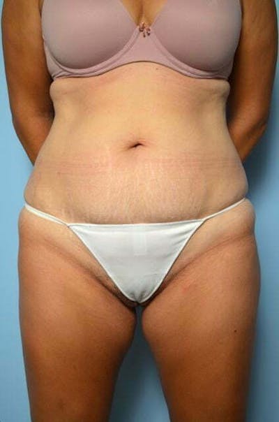 Tummy Tuck Before & After Gallery - Patient 267638 - Image 1