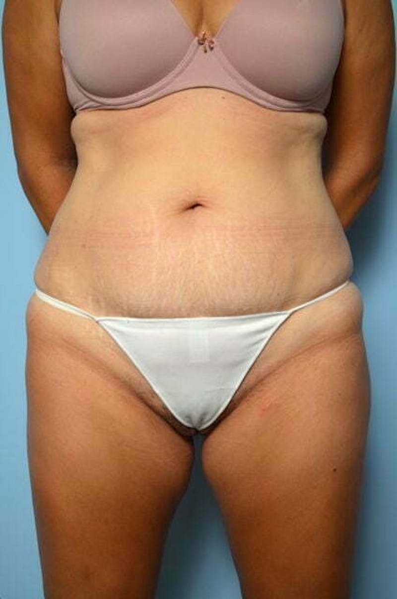 Tummy Tuck Before & After Gallery - Patient 267638 - Image 1