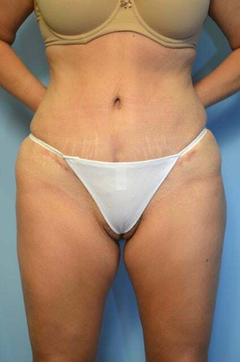 Tummy Tuck Before & After Gallery - Patient 267638 - Image 2