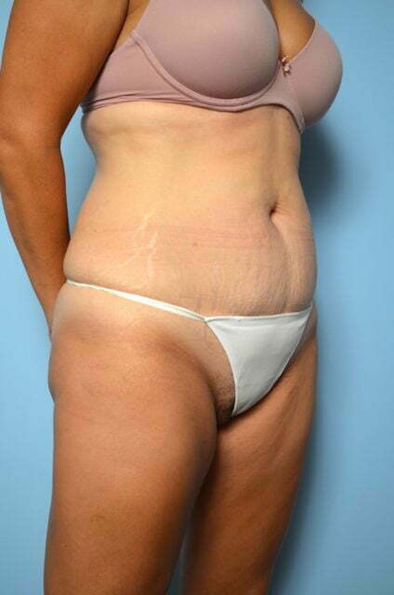 Tummy Tuck Before & After Gallery - Patient 267638 - Image 3