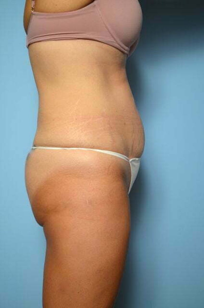 Tummy Tuck Before & After Gallery - Patient 267638 - Image 5