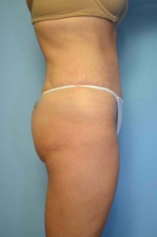 Liposuction Before & After Gallery - Patient 182224 - Image 6