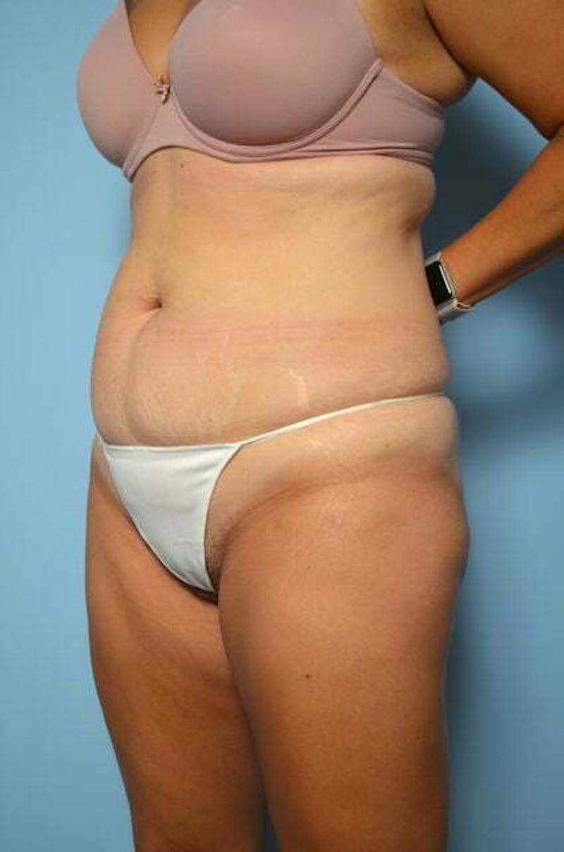 Tummy Tuck Before & After Gallery - Patient 267638 - Image 7