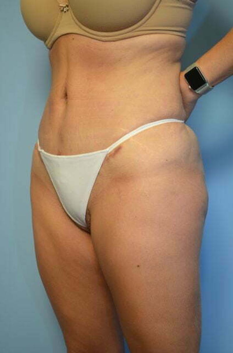 Tummy Tuck Before & After Gallery - Patient 267638 - Image 8
