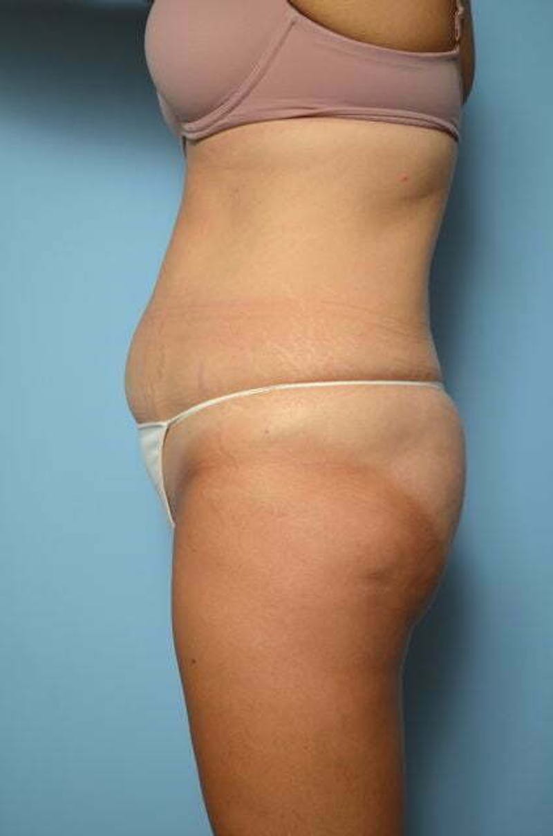 Tummy Tuck Before & After Gallery - Patient 267638 - Image 9