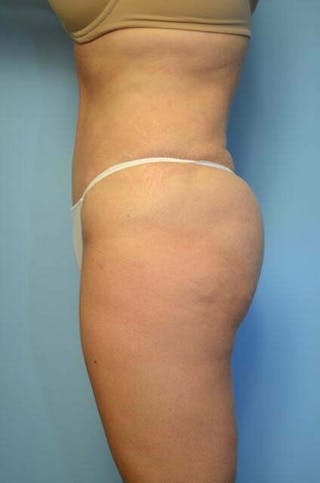 Liposuction Before & After Gallery - Patient 182224 - Image 10