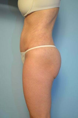 Liposuction Before & After Gallery - Patient 217969 - Image 10