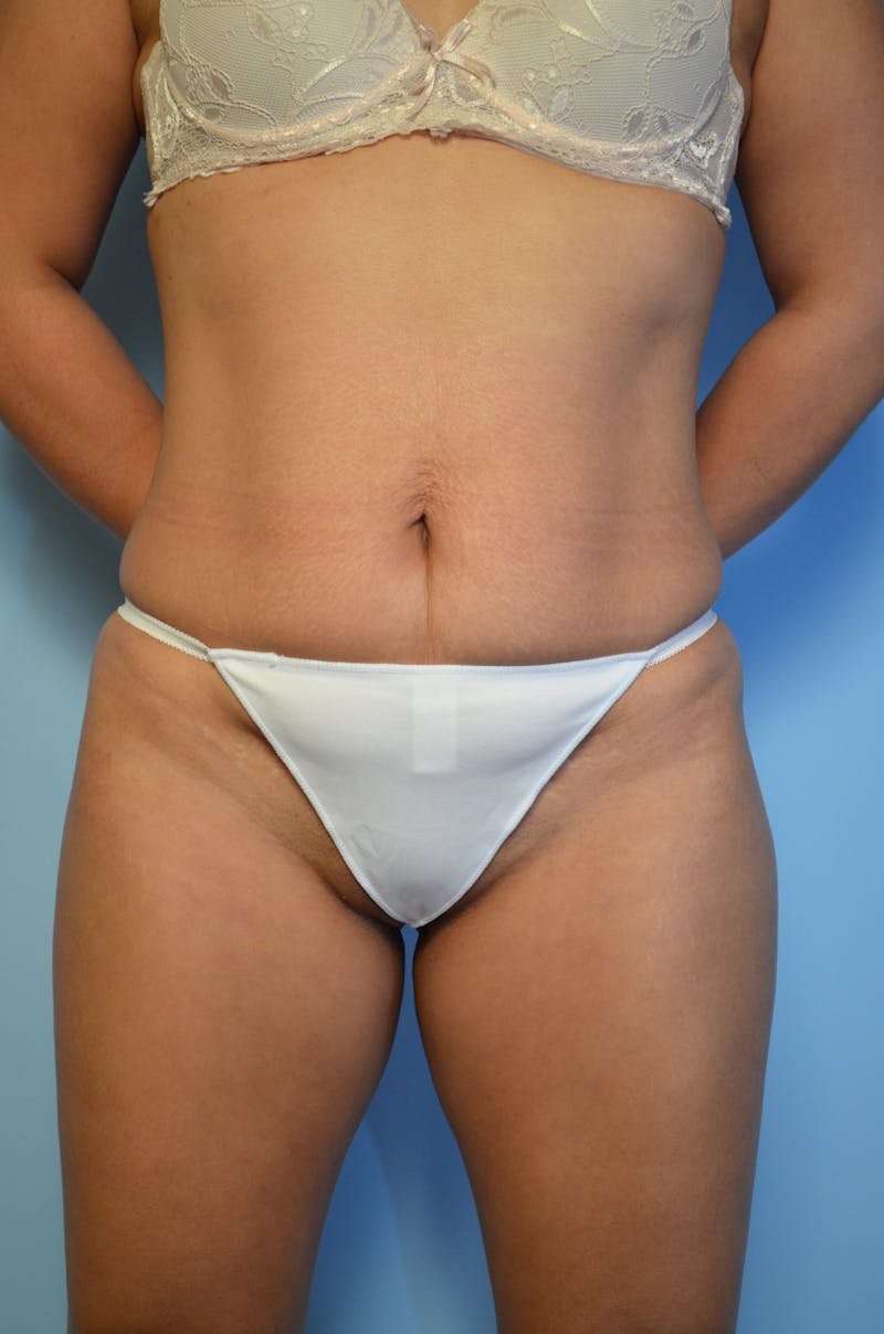Tummy Tuck Before & After Gallery - Patient 367336 - Image 1