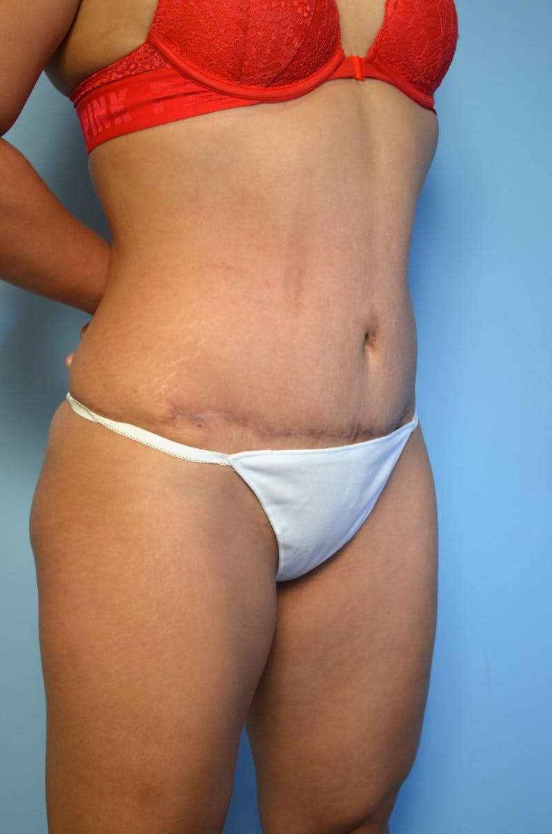 Tummy Tuck Before & After Gallery - Patient 367336 - Image 4