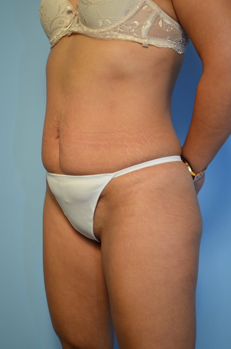Tummy Tuck Before & After Gallery - Patient 367336 - Image 7