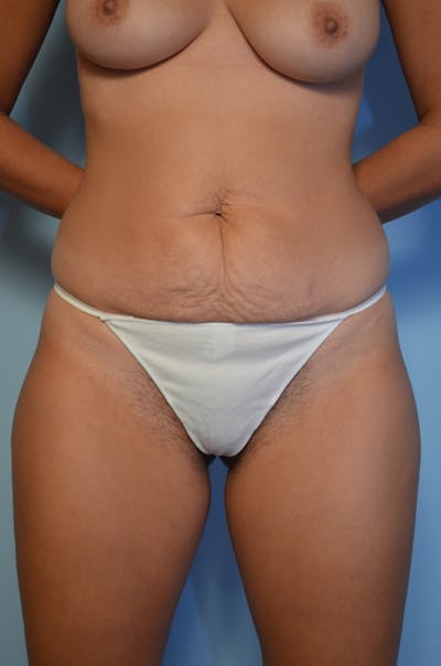 Tummy Tuck Before & After Gallery - Patient 144920 - Image 1