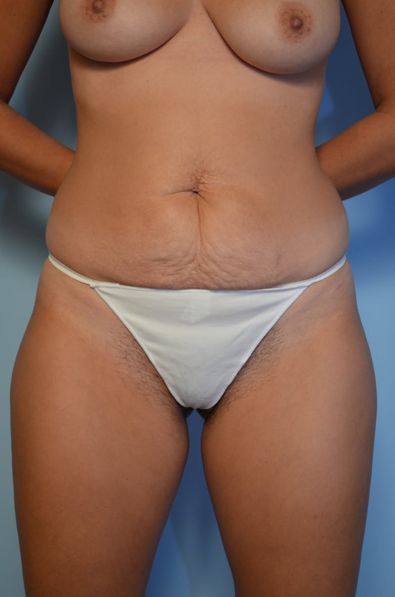 Tummy Tuck Before & After Gallery - Patient 144920 - Image 1