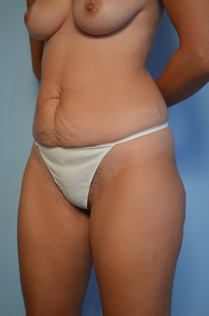 Tummy Tuck Before & After Gallery - Patient 144920 - Image 7